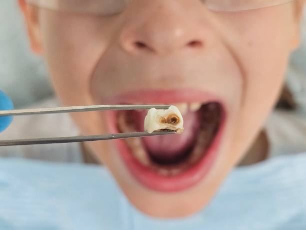 Best Knocked-Out Tooth Emergency  in Fremont, OH
